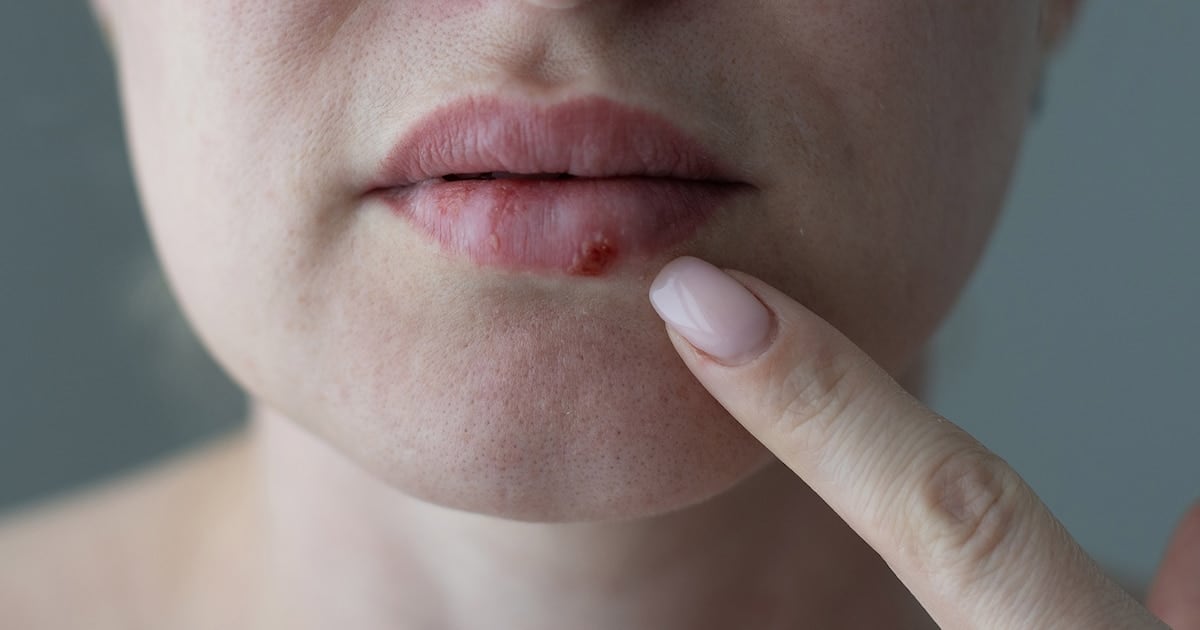 Pritelivir: la pastilla que rompe la resistencia del herpes en pacientes con defensas bajas